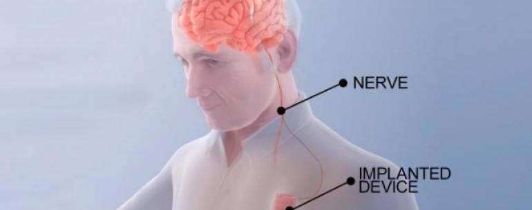 «Мозговой кардиостимулятор» может помочь пациентам быстрее оправиться от инсульта